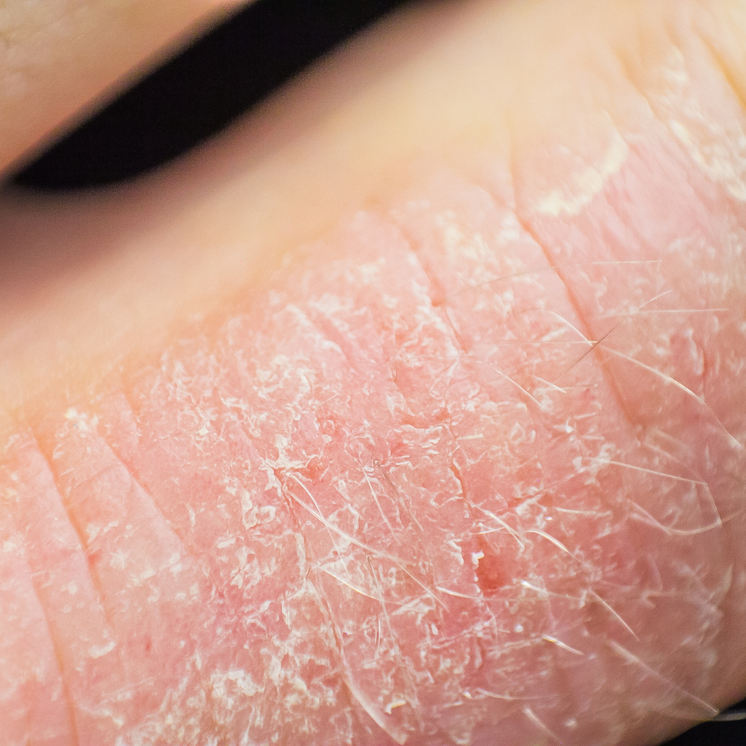 The Best Product for Soothing Eczema