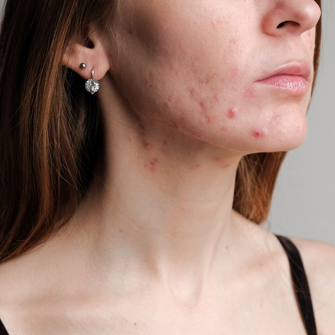 Top Foods to Eat and Avoid for Clear Skin and Acne-Free Complexion