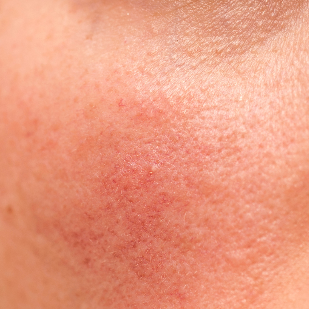 The Best Redness Reducing Product
