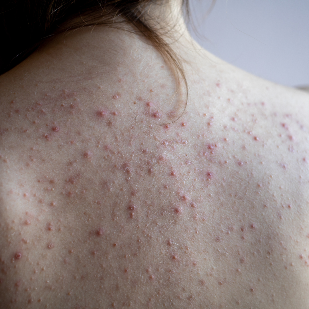 How To Get Rid Of Body Acne | Body Acne Wash