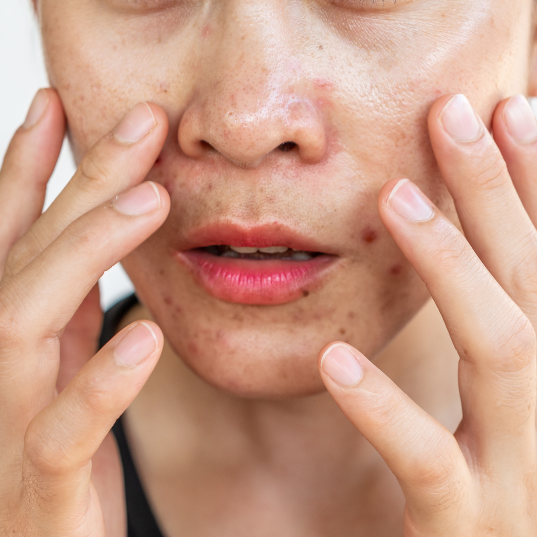 The 4 Best Products and Treatments for Persistently Oily Skin