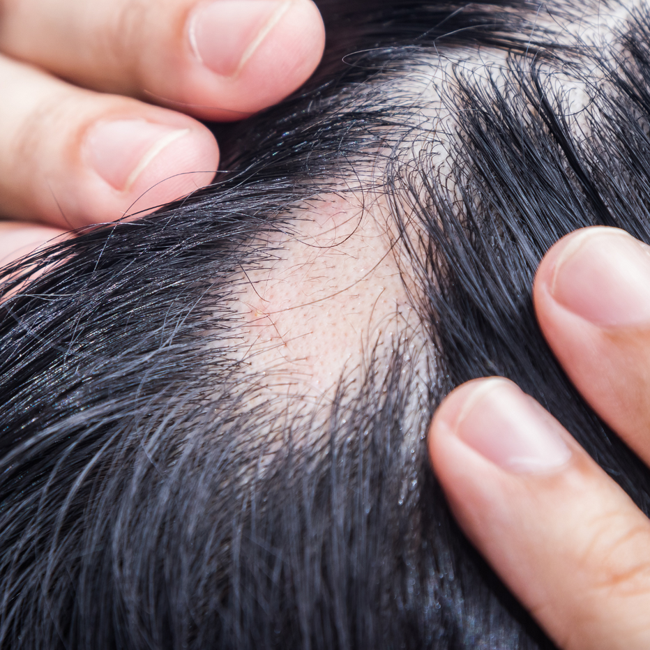 how-to-stop-alopecia-hair-loss-naturally-veenourish