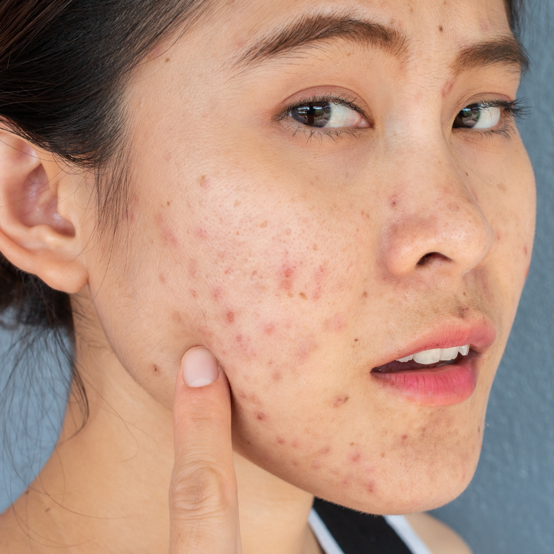 5 Products That Helped Fade My Post-Acne Dark Spots